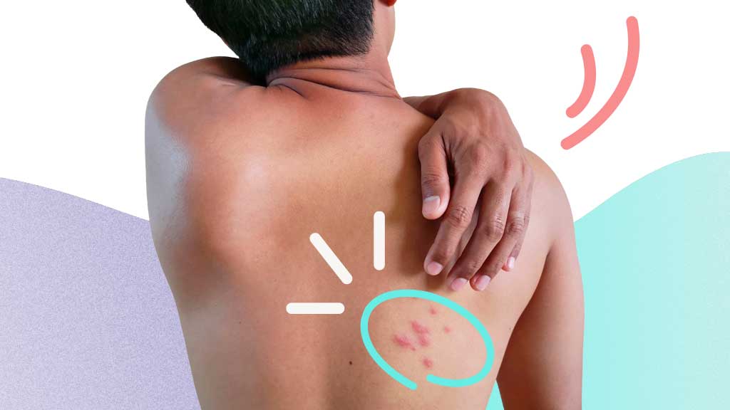 Shingles on the back: How to identify and other causes