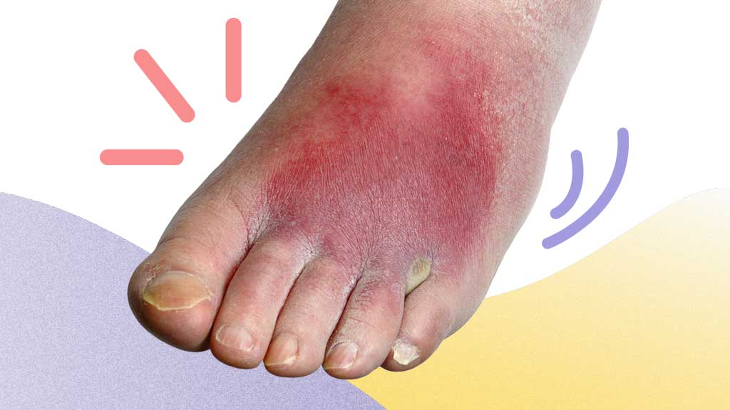 Image for Cellulitis: How Can We Reduce Hospitalisation Rates?